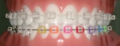 La imagen 3 de la Empresa BRACKETS CON ESTILO GUADALAJARA Salud y Medicina en Guadalajara JAL
